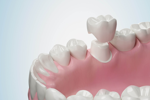 Can A Dental Crown Fail?