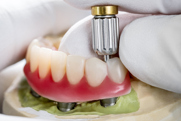 Get Dental Implants From An Experienced Implant Dentist