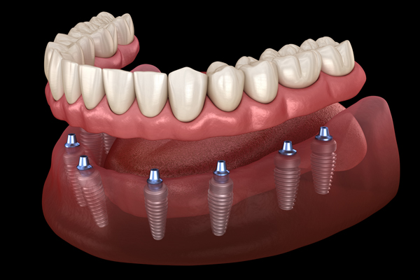 Fixed Vs Removable Implant Supported Dentures